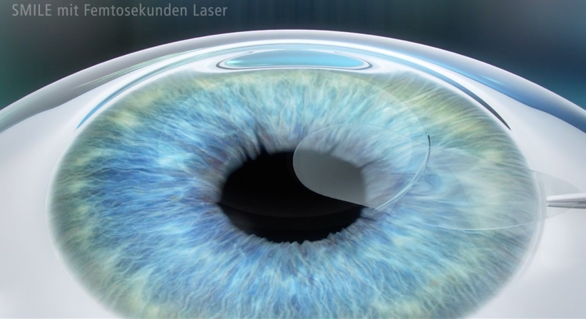 Relex SMILE - Prof. Dr. Dr.  Nikolaus Luft, FEBO, FWCRS - Augenarzt Linz 4020