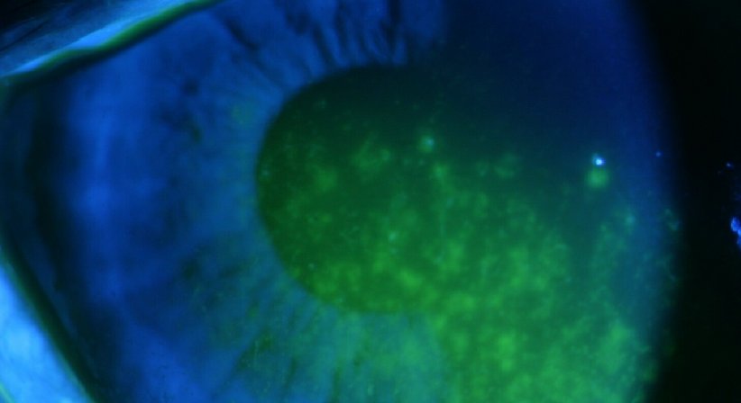 Trockenes Auge - Prof. Dr. Dr.  Nikolaus Luft, FEBO, FWCRS - Augenarzt Linz 4020