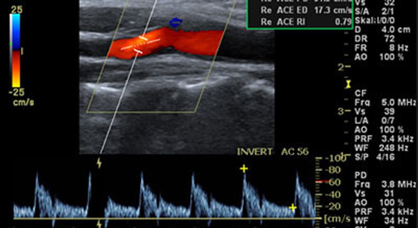 Carotis-Duplex - OA Dr. med. univ. Ahmed Zidan - Kardiologe Wien 1030