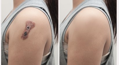 Entfernung von Hauttumoren