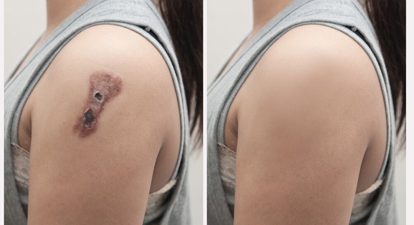 Entfernung von Hauttumoren - Dr. med. univ. Mo Pachala - Hautarzt Wien 1220