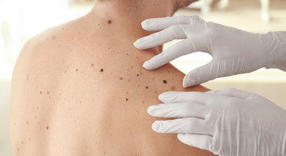 Hautkrebs Vor- und Nachsorge