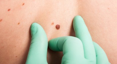 Muttermalkontrolle und –entfernung