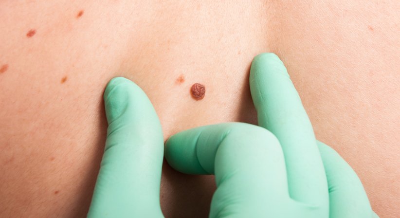 Muttermalkontrolle und –entfernung - Dr. med. univ. Mo Pachala - Hautarzt Wien 1220