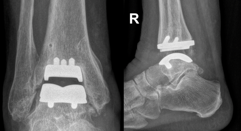 Fußchirurgie (Hallux valgus/rigidus u.a.), Gelenksersatz (Endoprothese) Sprunggelenk,  Knie und Hüfte  - Dr. med. univ. Judith Kloiber - Orthopädin Wien 1180