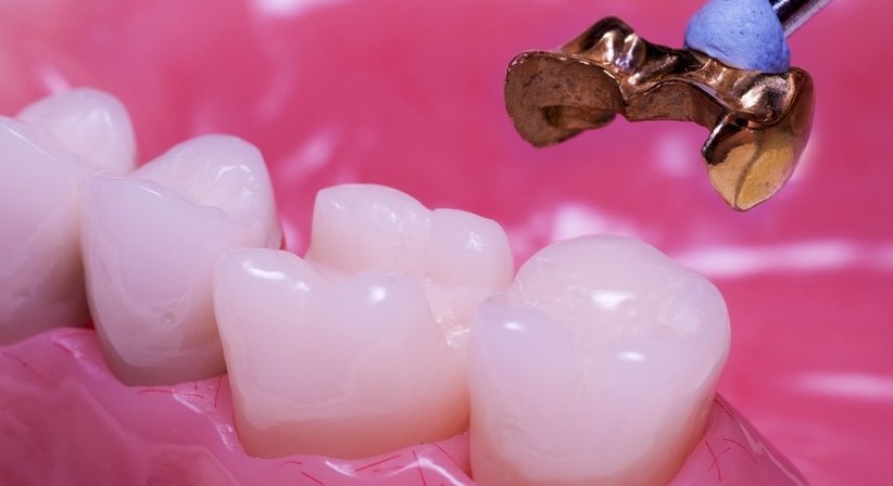 Kronen / Brücken - DDr. Vera Masic-Cabak - Zahnärztin Wien 1180