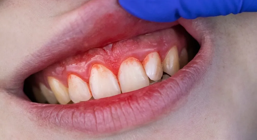 Parodontologie - DDr. Robert Mallinger - Zahnarzt Wien 1150