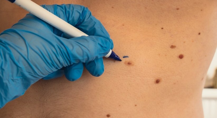 Hautkrebsvorsorge - Dr. Charlotte Marian - Hautärztin Wien 1170