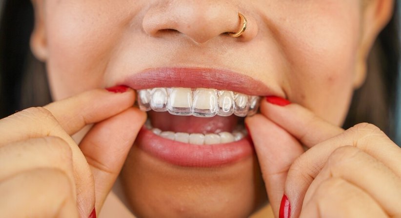 Unsichtbare Zahnspange (Aligner) - Dr. Andreas Cosma - Zahnarzt Krems an der Donau 3500