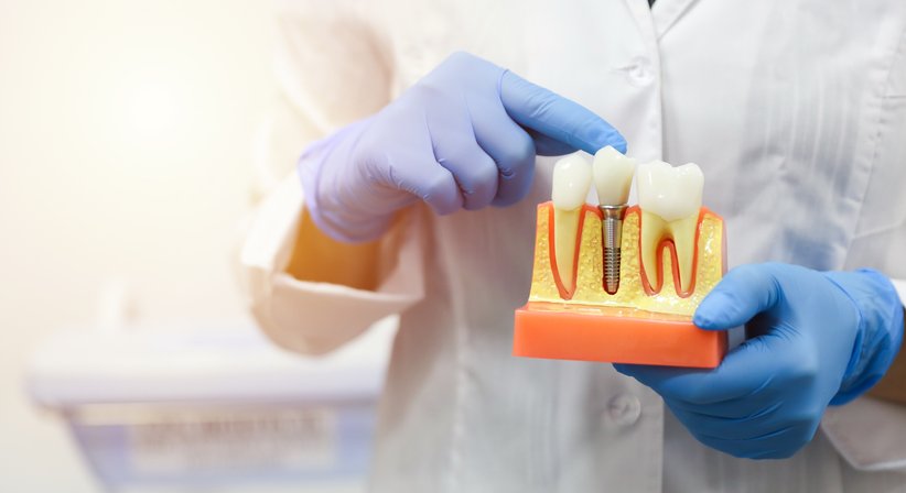 Zahnimplantate - Dr. Andreas Cosma - Zahnarzt Krems an der Donau 3500