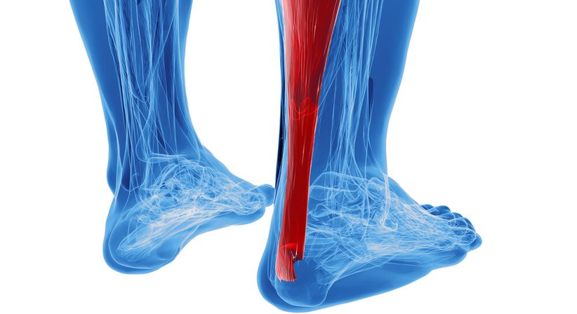 Achillessehnenriss - OA Dr. med. univ. Stefan Eipeldauer - Orthopäde Baden 2500