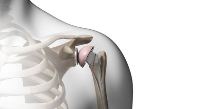 Omarthrose / Schulterprothese
