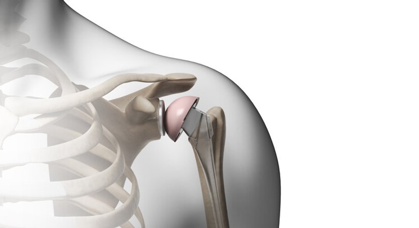 Omarthrose / Schulterprothese - OA Dr. med. univ. Stefan Eipeldauer - Orthopäde Baden 2500