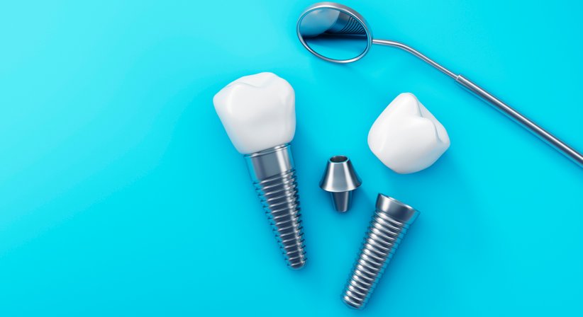 Dentale Implantate - DDr. Bernhard Stocker - Kieferchirurg Braunau am Inn 5280