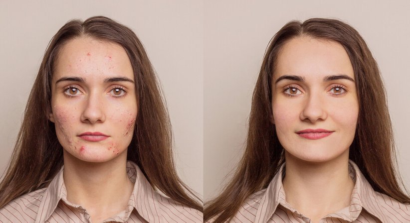 Akne - Dr. Isabella Arnoldner - Hautärztin Wien 1130