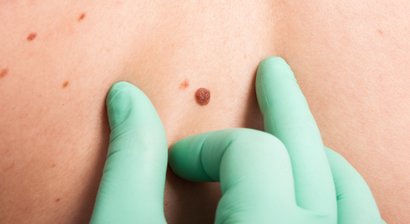 Muttermalkontrolle / Hautkrebs