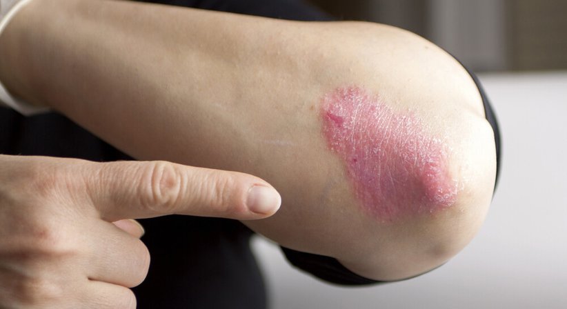 Psoriasis - Dr. Isabella Arnoldner - Hautärztin Wien 1130