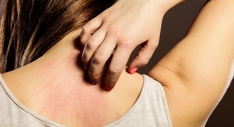 Trockene Haut / Ekzeme - Dr. Isabella Arnoldner - Hautärztin Wien 1130