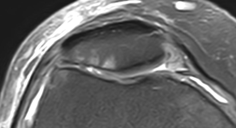 Knorpelschäden - OA Dr. Rupert Schuster - Orthopäde Wien 1070