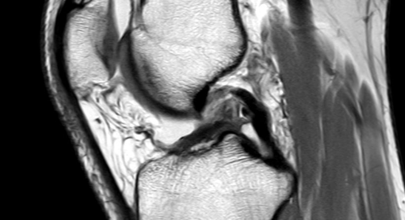 Kreuzbandriss - OA Dr. Rupert Schuster - Orthopäde Wien 1070