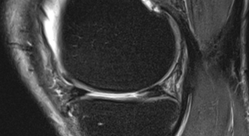 Meniskusriss - OA Dr. Rupert Schuster - Orthopäde Wien 1070