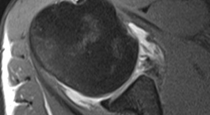 Schulterluxation (Schulterverrenkung, Instabilitäten)