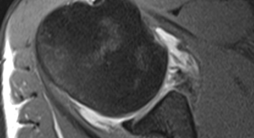 Schulterluxation (Schulterverrenkung, Instabilitäten) - OA Dr. Rupert Schuster - Orthopäde Wien 1070