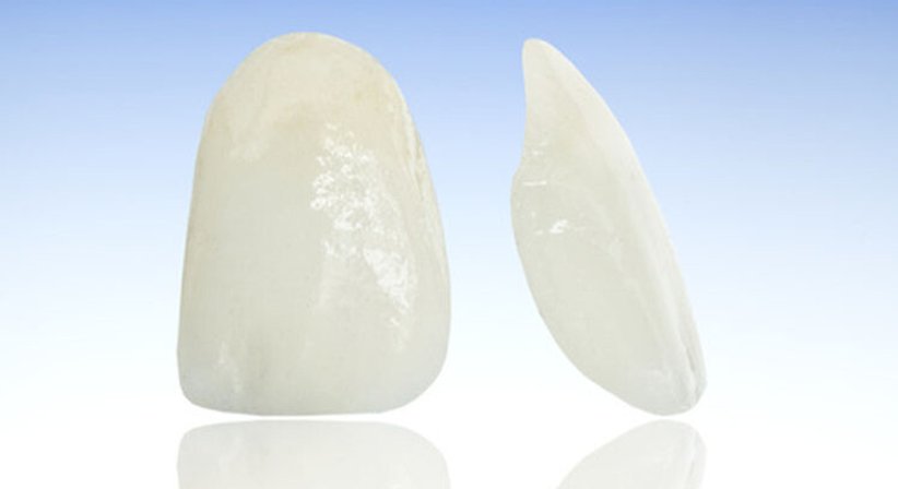 Veneers - Dr. Peter Brandstätter, MSc - Zahnarzt Wien 1010