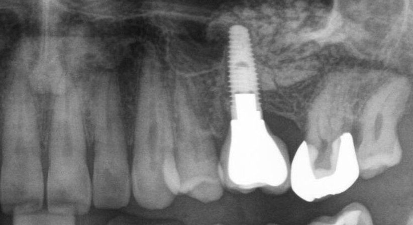 Implantate - Dr. Peter Brandstätter, MSc - Zahnarzt Wien 1010