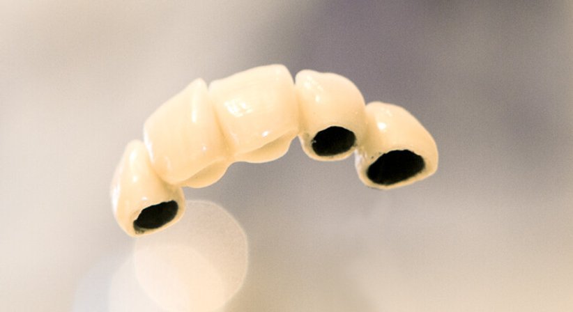 Kronen & Brücken - Dr. Peter Brandstätter, MSc - Zahnarzt Wien 1010