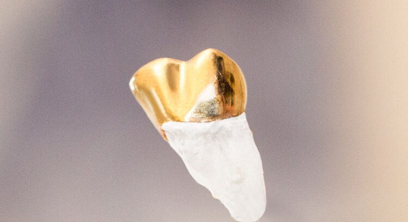 Füllungen & Amalgam – Sanierung - Dr. Peter Brandstätter, MSc - Zahnarzt Wien 1010