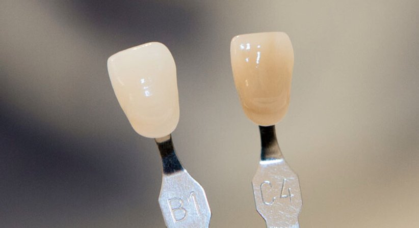 Bleaching - Dr. Peter Brandstätter, MSc - Zahnarzt Wien 1010