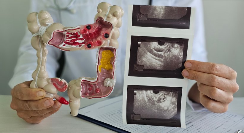 Darmspiegelung - Dr. Johannes Weilhartner - Internist Salzburg 5020