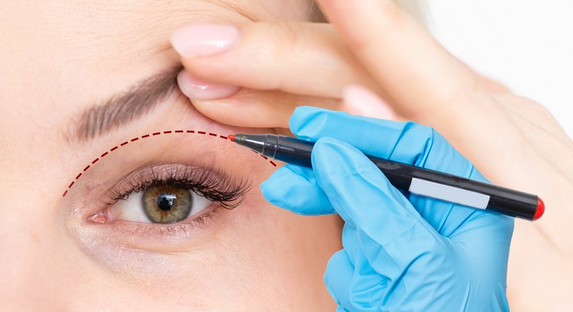 Augenlidkorrektur - Doz. Dr. Georg Huemer - Plastischer Chirurg Wels 4600