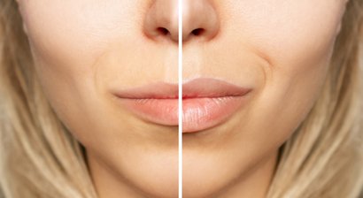 Lippen aufspritzen (Lippenkorrektur)