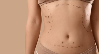 Bauchstraffung: in Kombination mit einer Vaser®-Fettabsaugung 