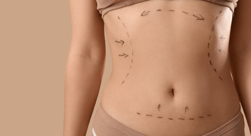 Bauchstraffung: in Kombination mit einer Vaser®-Fettabsaugung  - Doz. Dr. Georg Huemer - Plastischer Chirurg Wels 4600