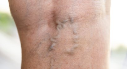 Krampfaderbehandlung (Katheteroperation/Verödung)