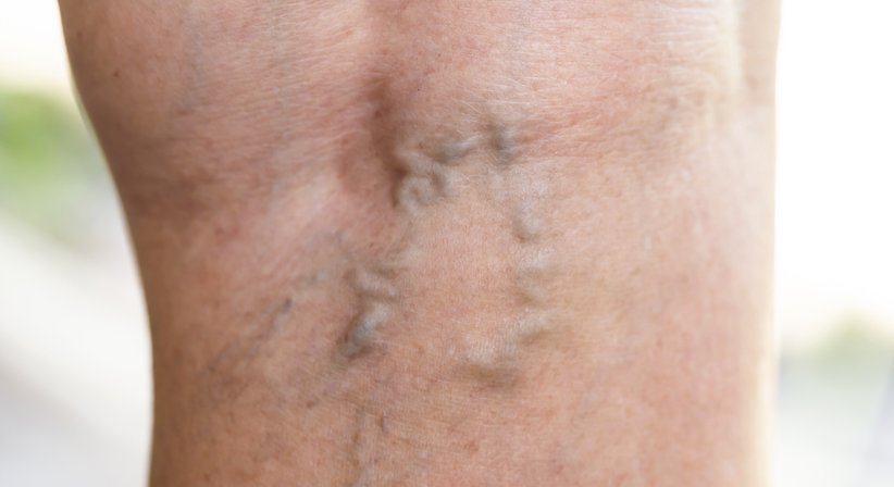 Krampfaderbehandlung (Katheteroperation/Verödung) - Dr. Spiro Silvester Schuller - Hautarzt Amstetten 3300