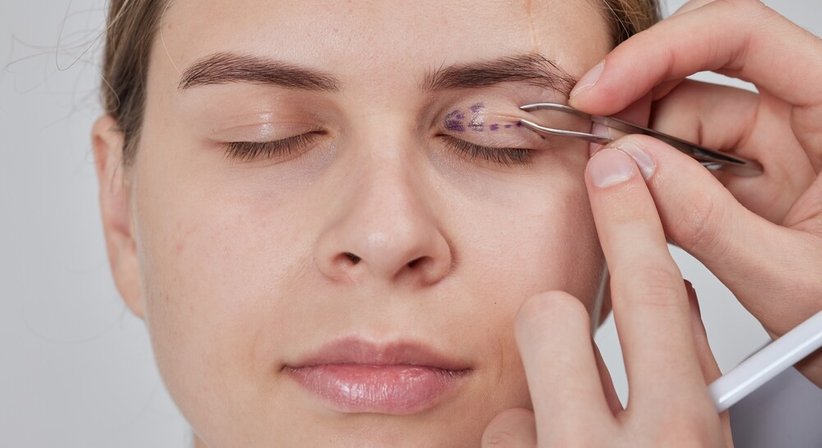 Lidstraffung (Blepharoplastik) - Dr. Spiro Silvester Schuller - Hautarzt Amstetten 3300