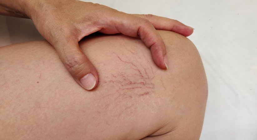 Besenreiserbehandlung (Schaumverödung/Laser) - Dr. Spiro Silvester Schuller - Hautarzt Amstetten 3300