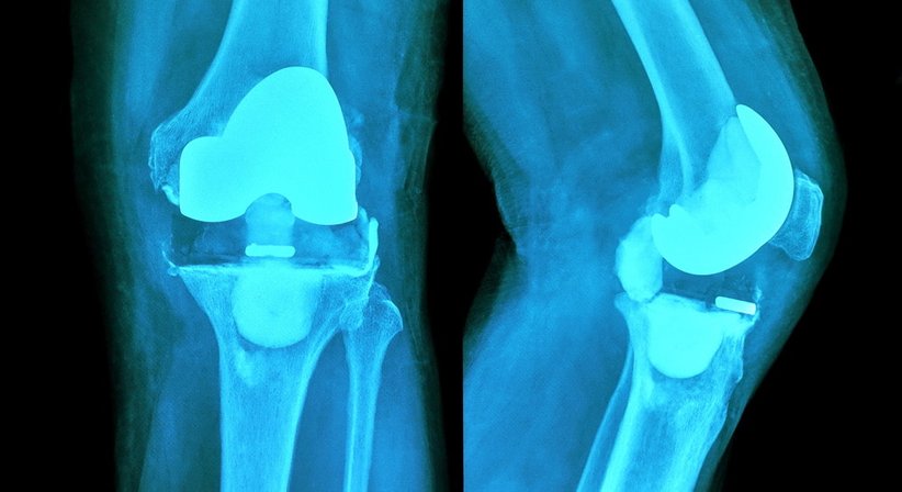 Knieprothese - Prof. Dr. Klaus Schatz - Orthopäde Wien 1190