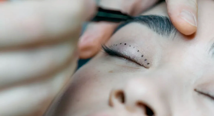 Plastische Lidoperationen - OA Dr. med. univ. Reza Fazeli - Augenarzt Wien 1220