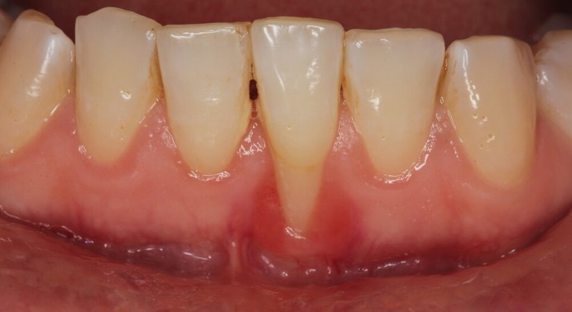 Parodontalbehandlung - Dr. Dr. med. univ. Johannes Küfler - Zahnarzt Illmitz 7142