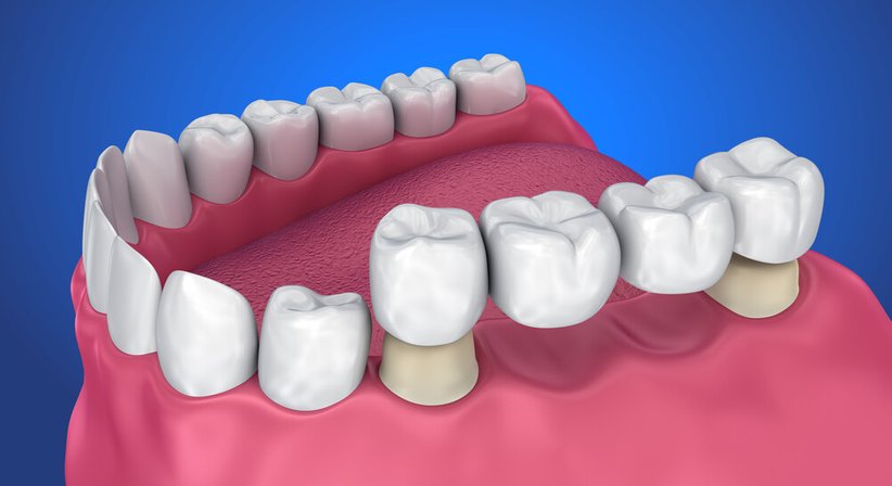 Zahnkronen und Zahnbrücken - Dr. Dr. med. univ. Johannes Küfler - Zahnarzt Illmitz 7142