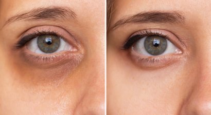 Augenringe entfernen