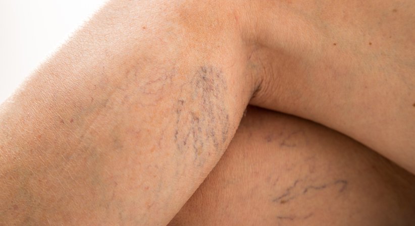 Besenreiser entfernen  - Dr. med. univ. Peter Herndlhofer - Allgemeinchirurg/Viszeralchirurg Wien 1060