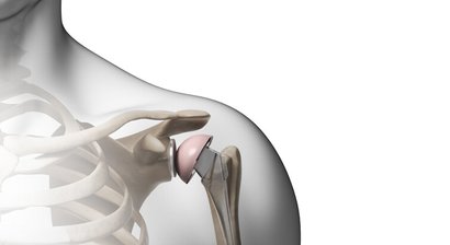 Schulterendoprothesen (Künstliches Schultergelenk) bei Arthrose