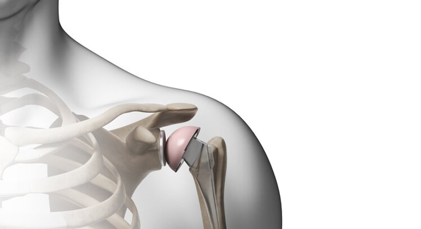 Schulterendoprothesen (Künstliches Schultergelenk) bei Arthrose - OA Dr. Dominik Meraner - Orthopäde Wien 1190