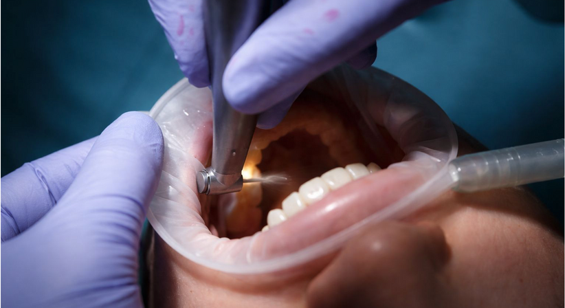 Zahnerhaltung - Dr. Sarah Abdel-Hamied - Zahnärztin Wien 1050